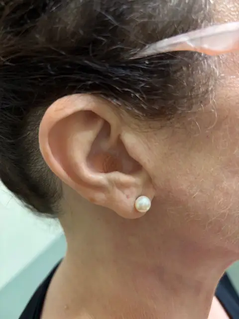Soliman Auricular Allergy Treatment Greensboro NC SAAT Ear Needle