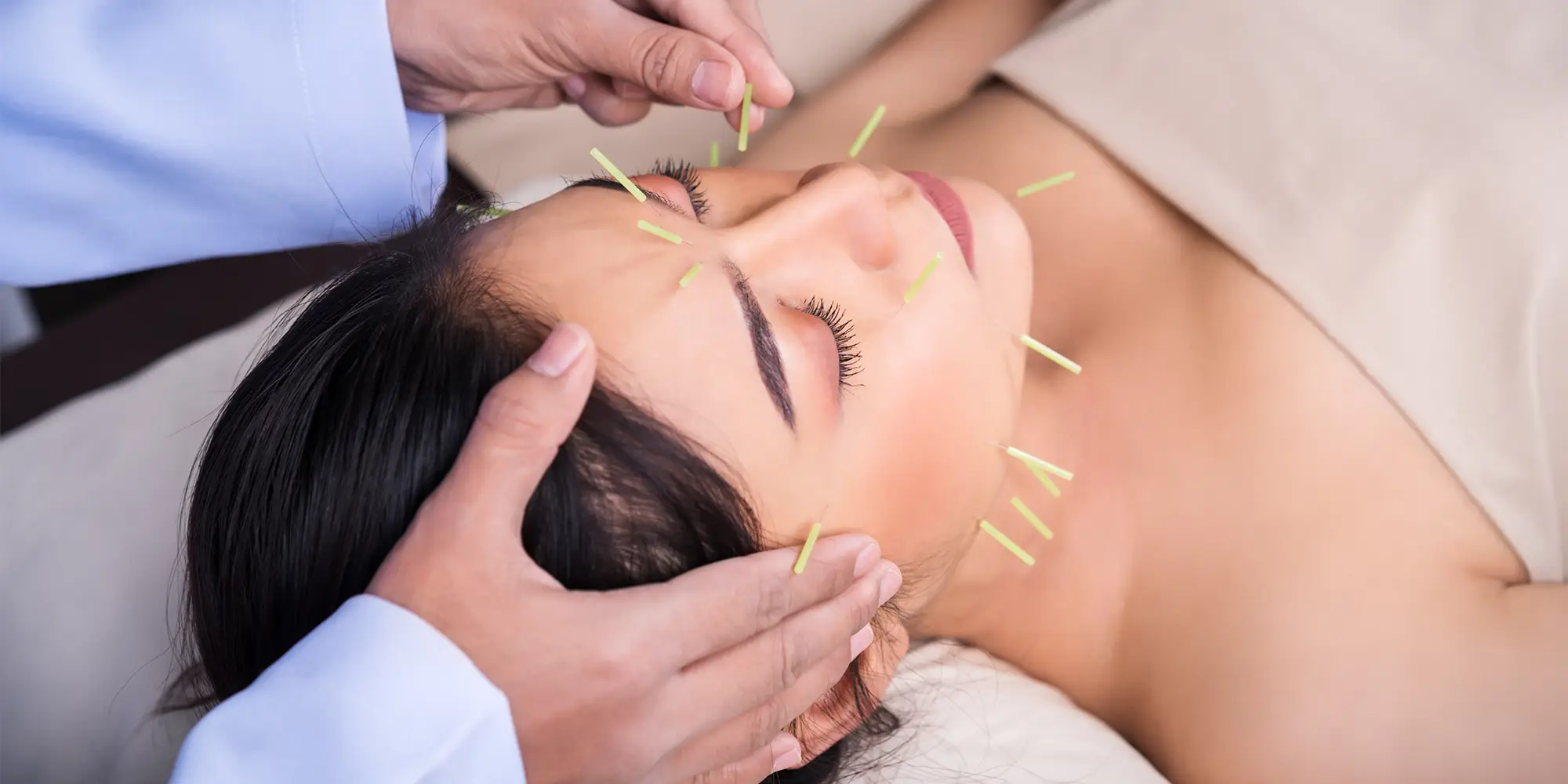 Microneedling & Cosmetic Acupuncture Greensboro NC Woman Receiving Acupuncture Microneedling & Cosmetic Acupuncture Greensboro NC Woman Receiving Acupuncture